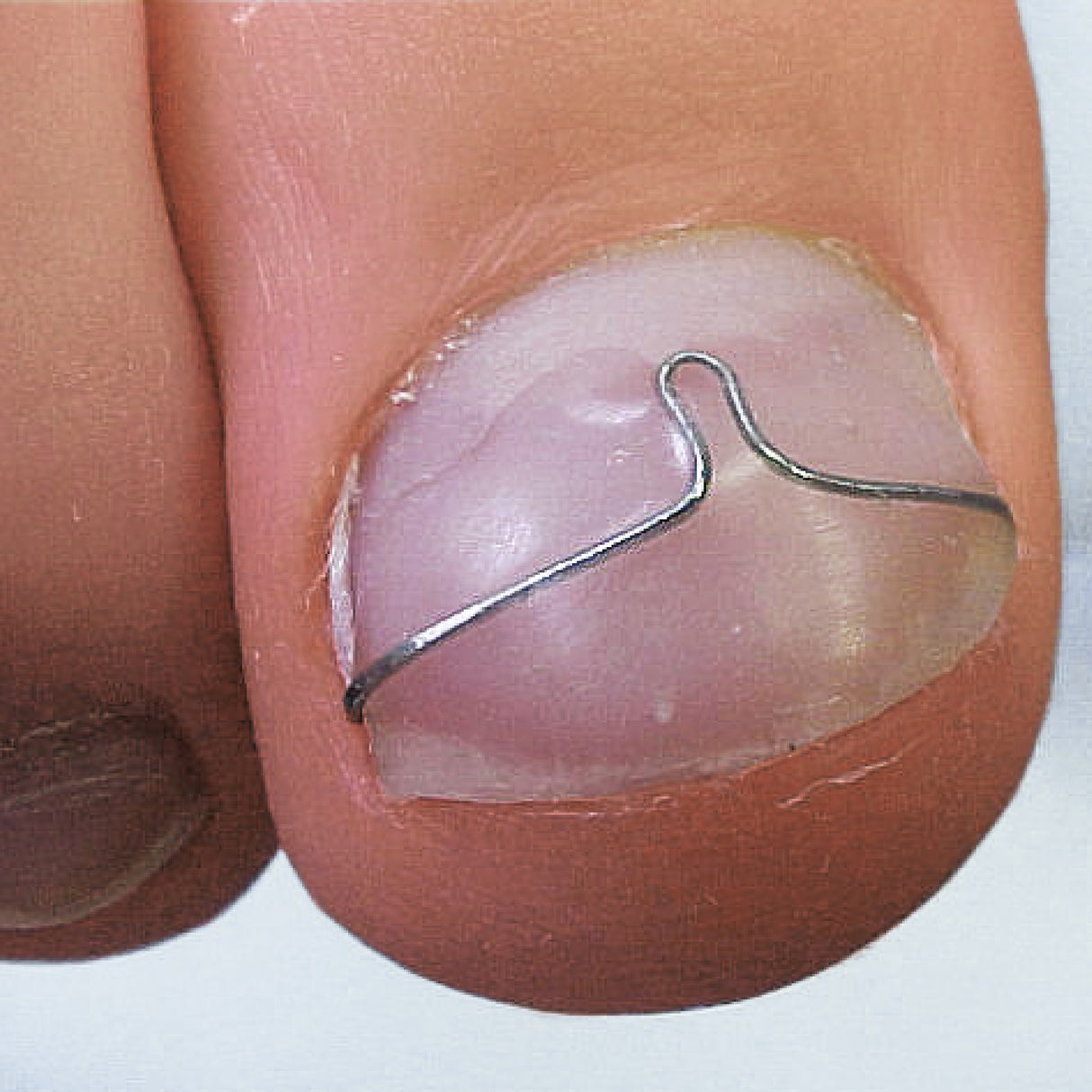 ROSS-FRASER apaļstieple nagu protezēšanai - dynasty.lv