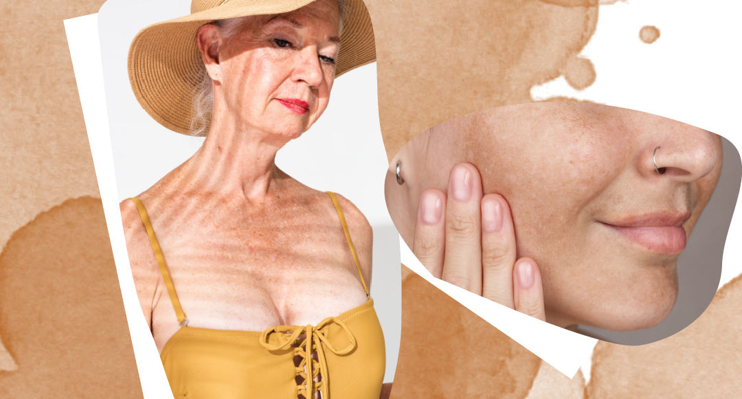 Hiperpigmentācija - 2 pazīmes, ka tev tā ir!