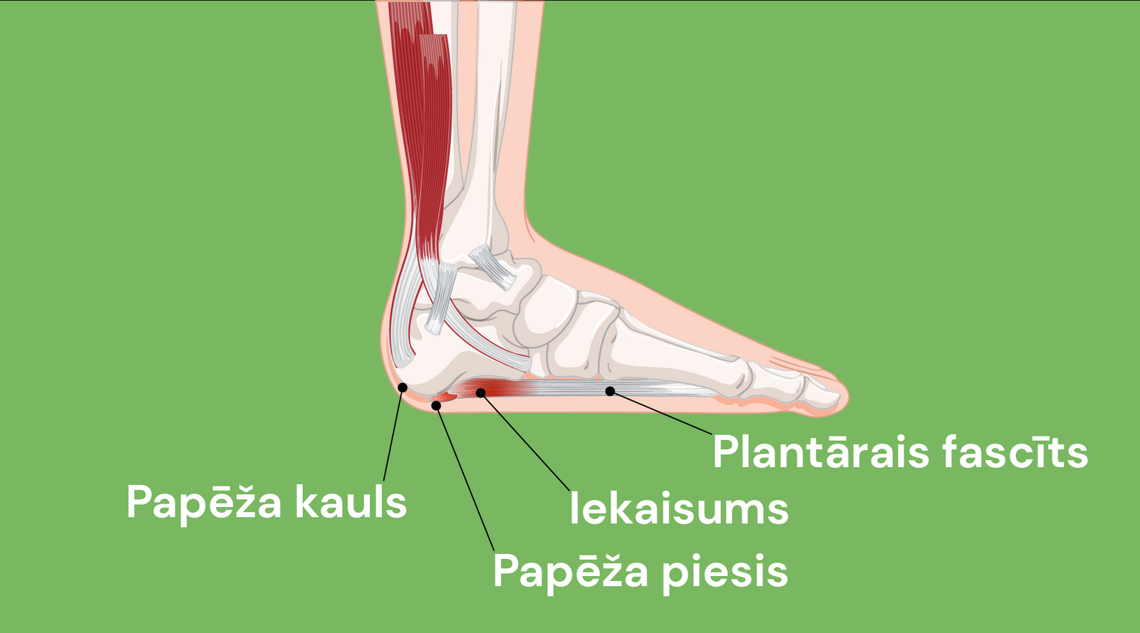 Plantārais fascīts - iekaisuma cēloņi un risinājumi