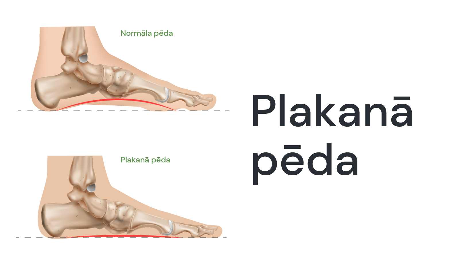 Plakanā pēda: cēloņi un risinājumi