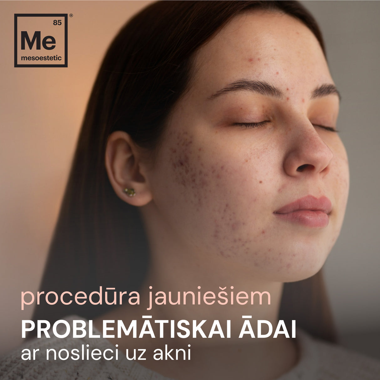 Sejas procedūra pusaudžiem- problemātiskai ādai ar noslieci uz akni