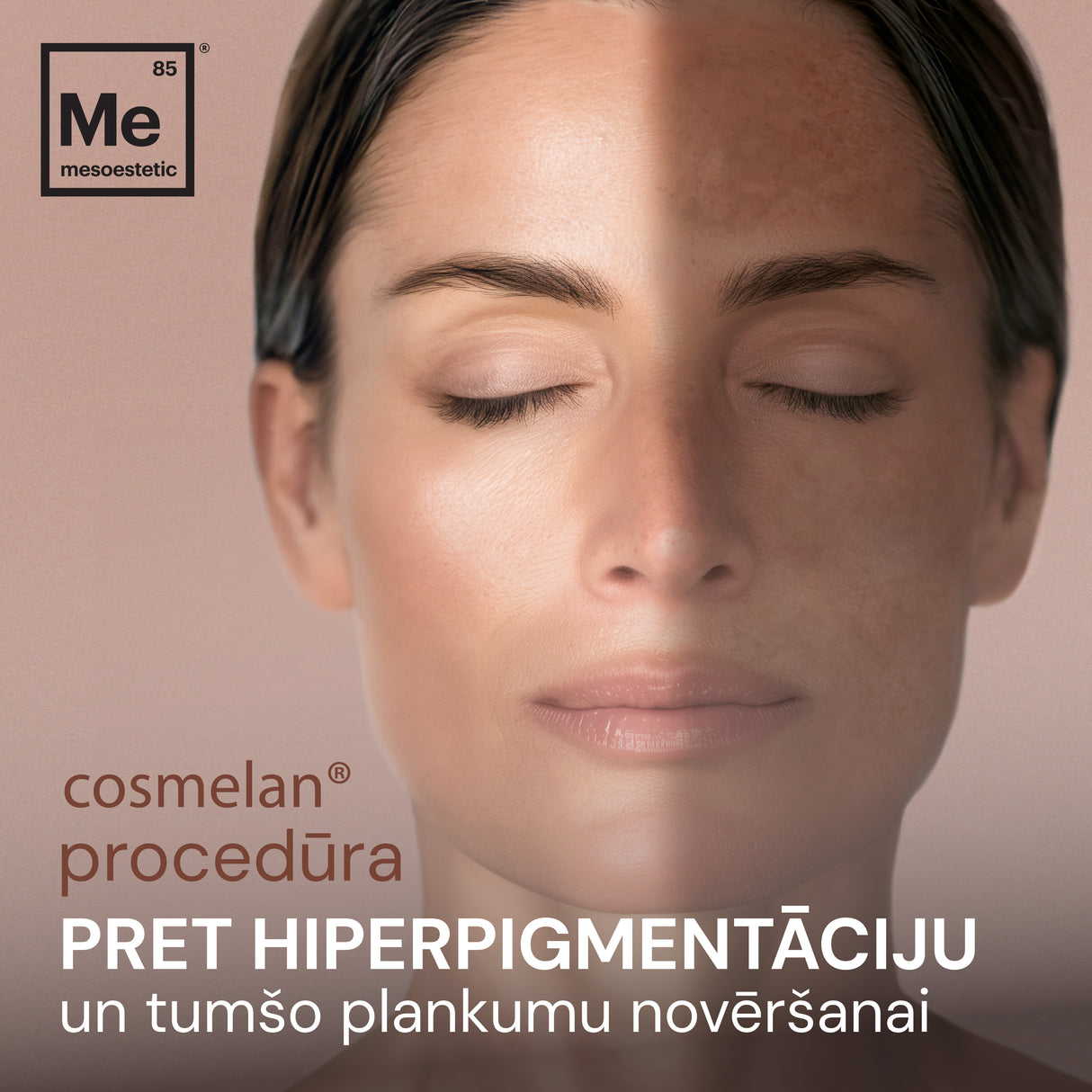 cosmelan® procedūra hiperpigmentācijas un tumšo plankumu novēršanai